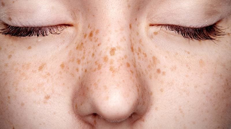 Use Of Microdermabrasion In The Treatment Of Freckles And Sunburn