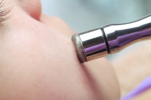 Use Of Microdermabrasion In The Treatment Of Open Pores 300x200 1