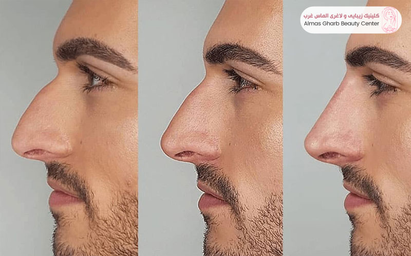 عوامل موثر بر هزینه نخ بینی
