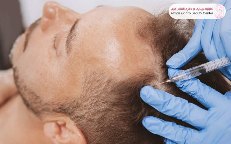 قیمت مزوتراپی مو در سال 1404