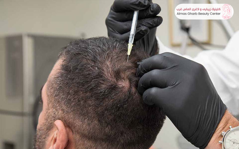 نقش مواد و کوکتل‌های مورد استفاده در قیمت مزوتراپی مو