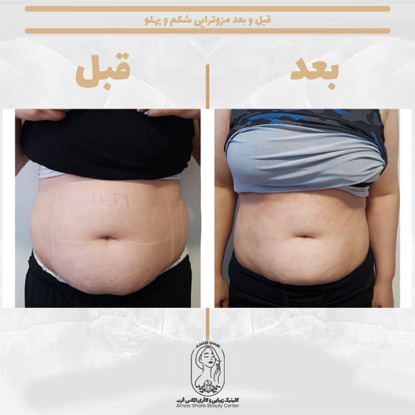 قبل و بعد مزوتراپی شکم و پهلو 3