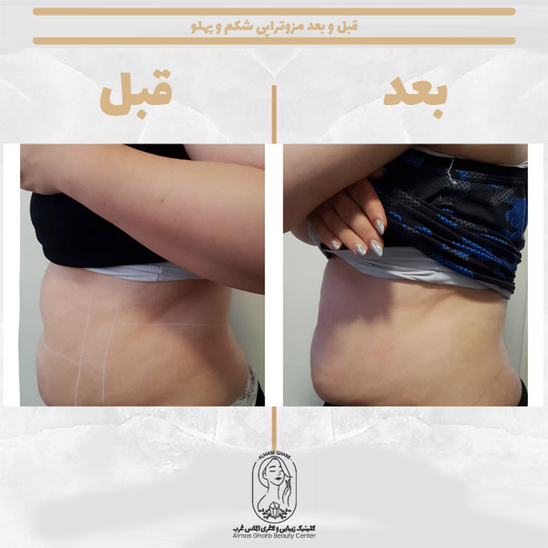 قبل و بعد مزوتراپی شکم و پهلو 4