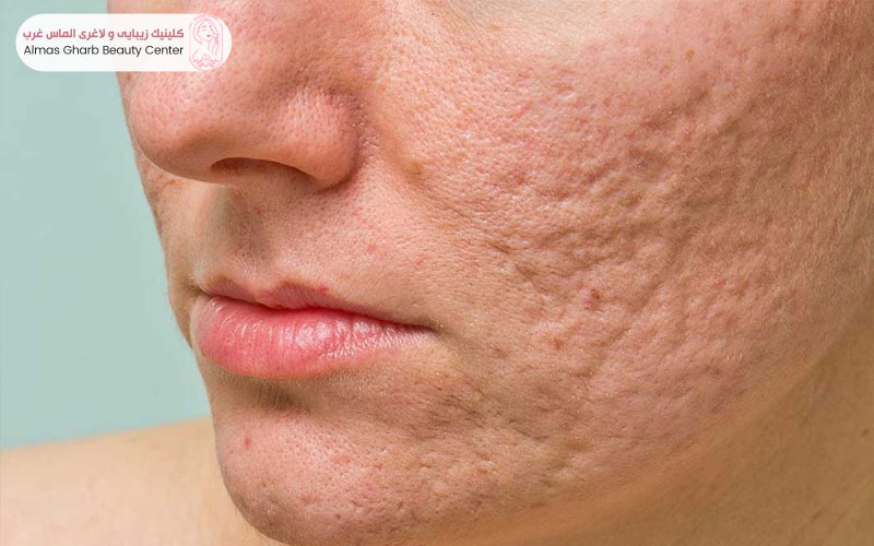 آکنه چیست و چرا ایجاد می‌شود؟
