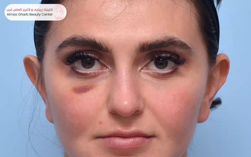 اصلاح عوارض فیلر زیر چشم با تخلیه ژل و تزریق آنزیم