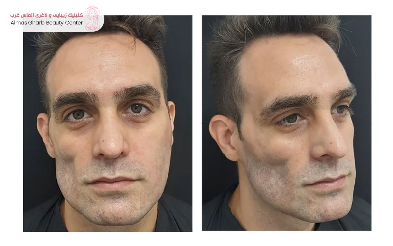 بازسازی چهره پس از تخلیه ژل و تزریق آنزیم